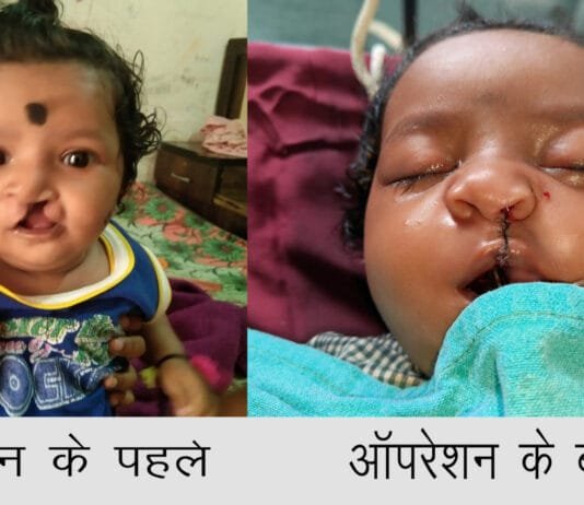 रायपुर : चिरायु योजना ने लौटाई मासूमों की मुस्कान…